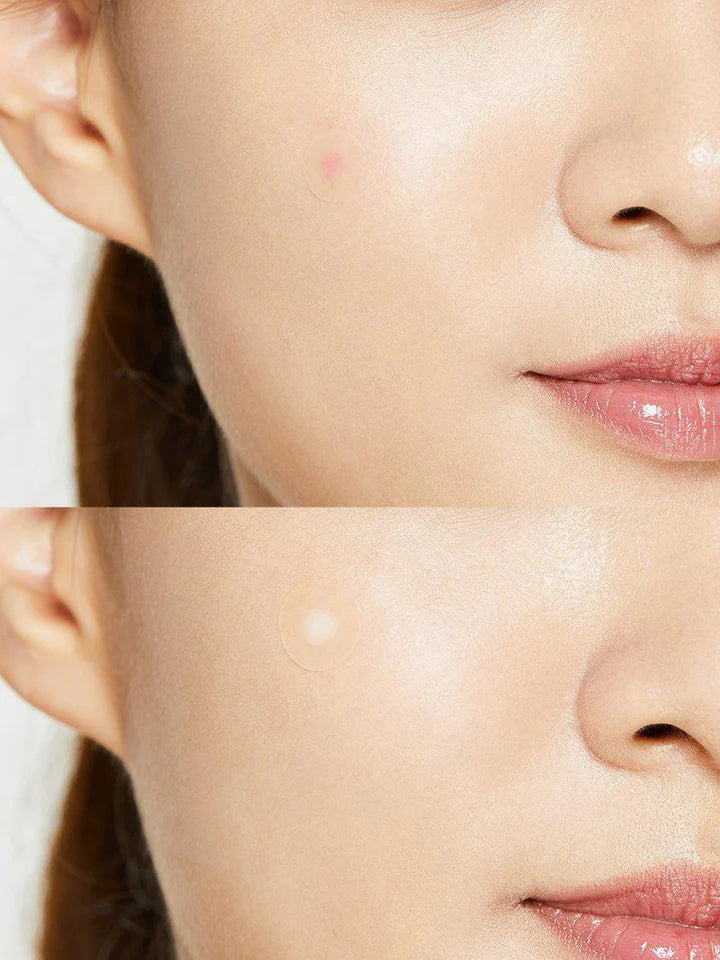 COSRX Acne Pimple Master Patch – Ngjitëse Hidrokoloide për Akne